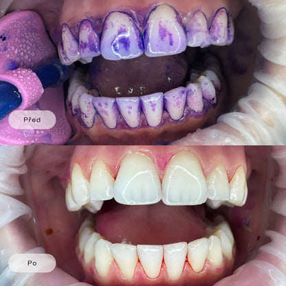 Dr. Dent: V34 Bělící Pásky na Zuby